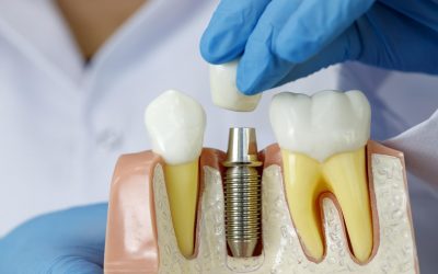 implant dentaire