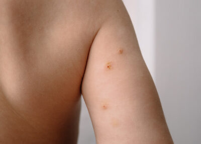 MOLLUSCUM CONTAGIOSUM